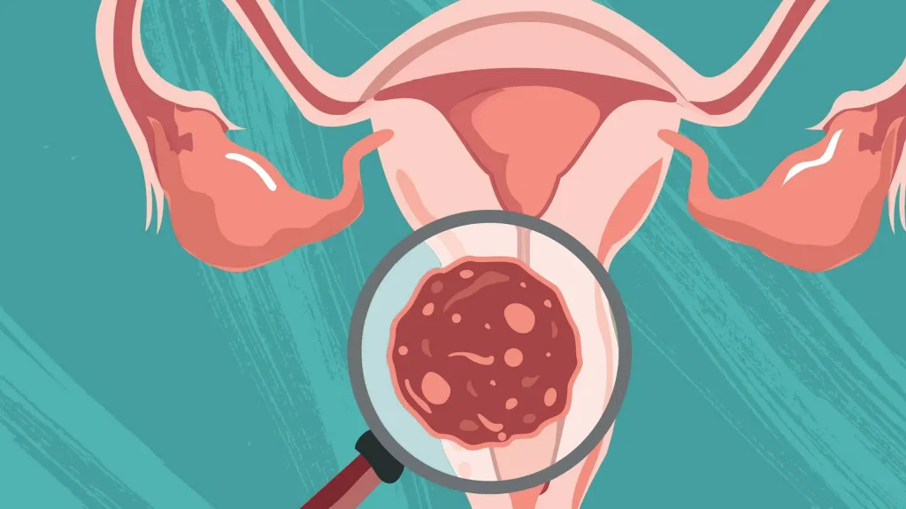 O καρκίνος του τραχήλου της μήτρας μπορεί να προληφθεί