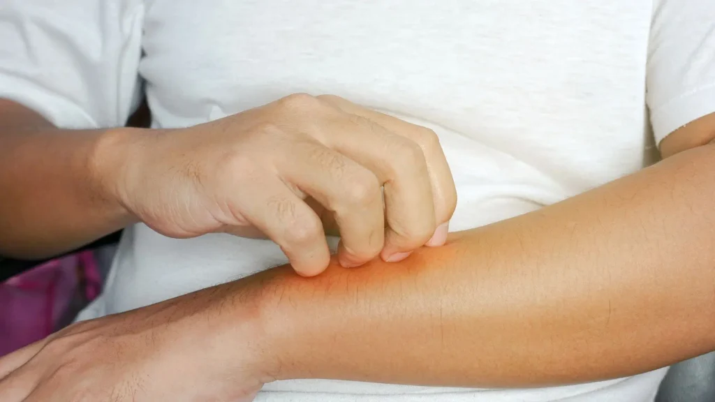 Διαπυητική Ιδρωταδενίτιδα diapyitiki-idrotadenitida