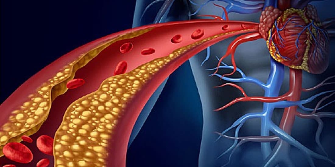 Η έκθεση σε τοξικά μέταλλα αυξάνει τον κίνδυνο αθηροσκλήρωσης