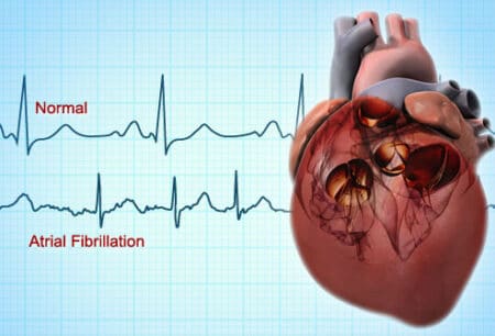 Rivaroxaban: Επιβεβαιώνονται τα οφέλη για ασθενείς με μη βαλβιδική κολπική μαρμαρυγή