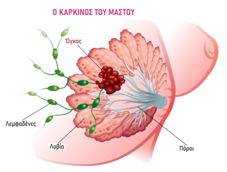 karkinos-mastou