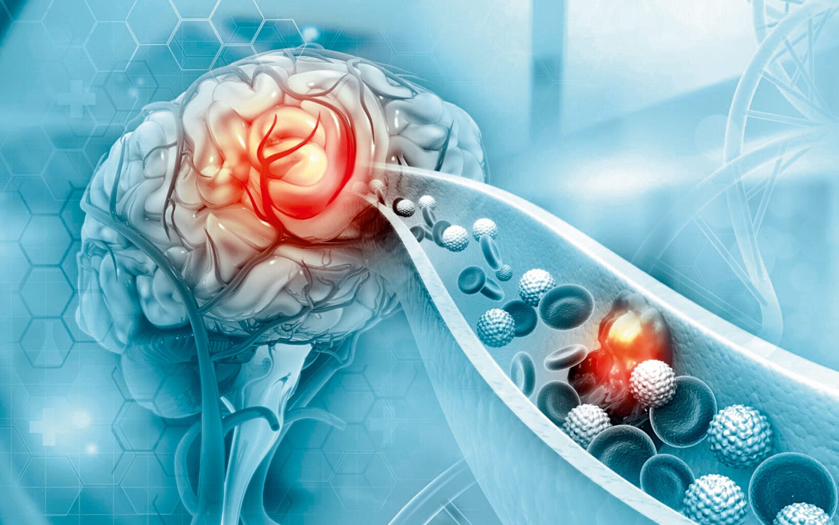 Θρομβεκτομή: Η «χρυσή» θεραπεία για τα βαριά εγκεφαλικά επεισόδια θρομβεκτομή