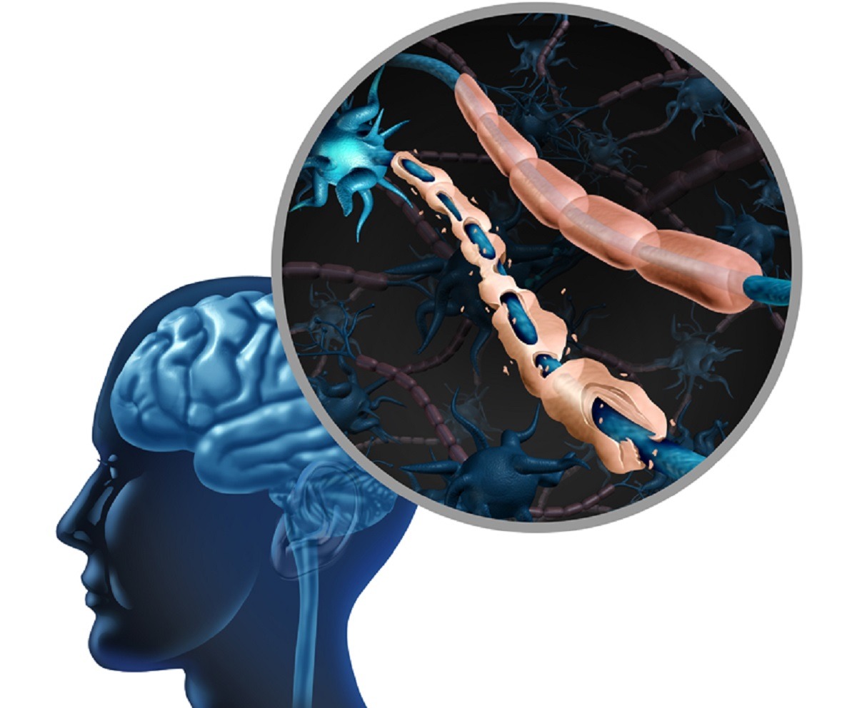 Εξελίξεις στη θεραπευτική αντιμετώπιση της Σκλήρυνσης κατά Πλάκας σκλήρυνση κατά πλάκας