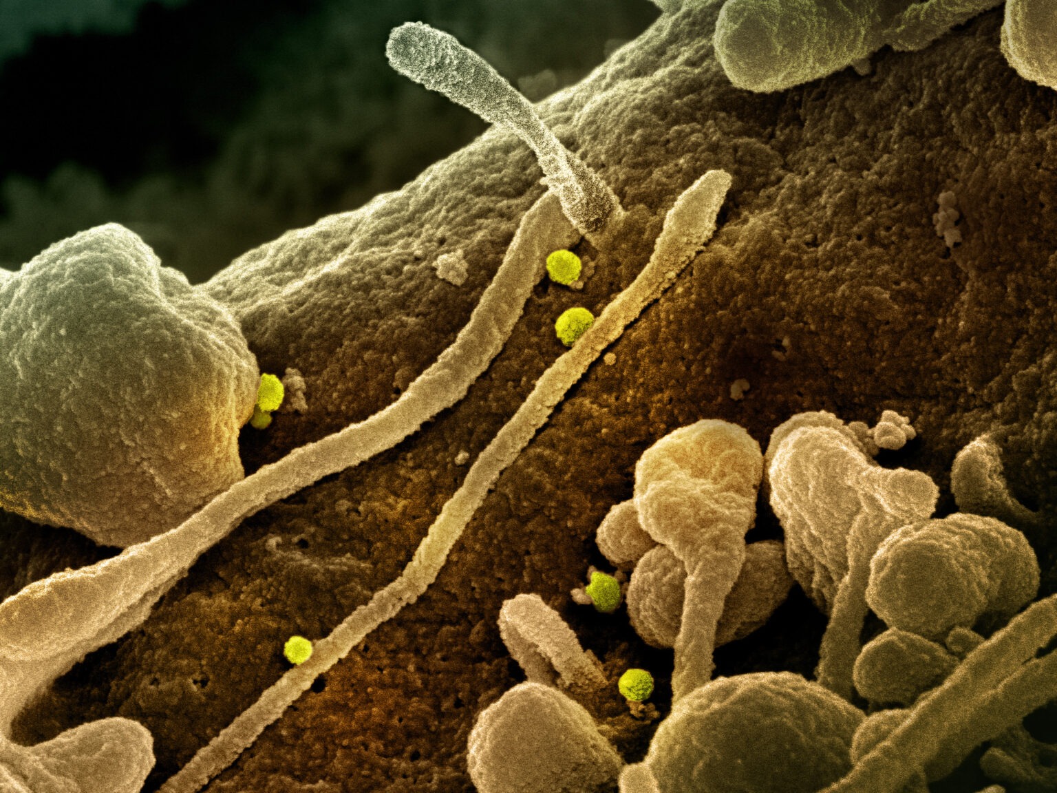 Αιμορραγικός Πυρετός Κριμαίας-Κονγκό στη Θεσσαλία: Το χρονικό, η αντιμετώπιση και οι προκλήσεις