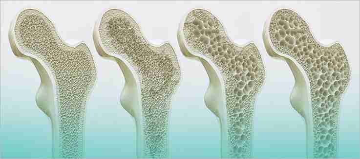 Πως επηρεάζει η εμμηνόπαυση την υγεία των οστών – Η σημασία της πρόληψης osteoporosi-