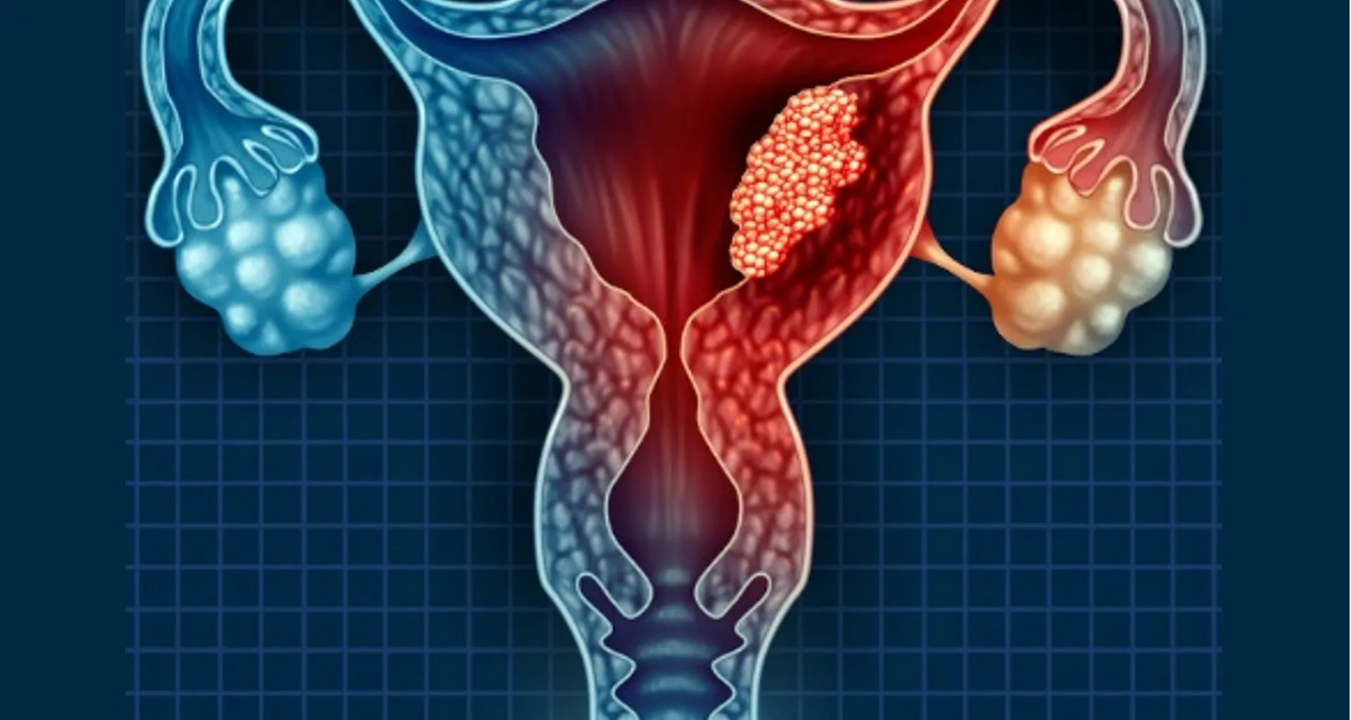 Νέα όπλα κατά του καρκίνου τραχήλου και ωοθηκών: Τα πιο ελπιδοφόρα δεδομένα από το Συνέδριο ESMO GYN 2025