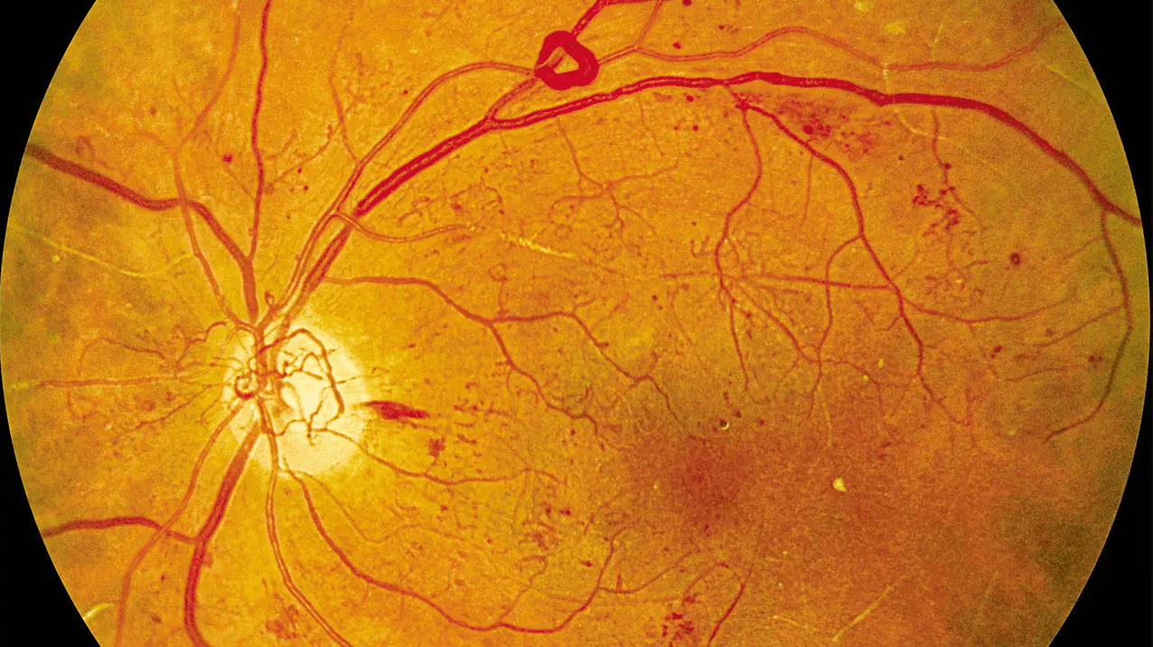 Σεμαγλουτίδη: Η νέα ελπίδα για την προστασία από τη διαβητική αμφιβληστρο-ειδοπάθεια – Ελληνική Μελέτη
