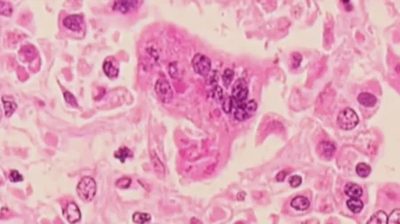 Λος-Άντζελες:-Θάνατος-παιδιού-από-σπάνια-επιπλοκή -λαράς