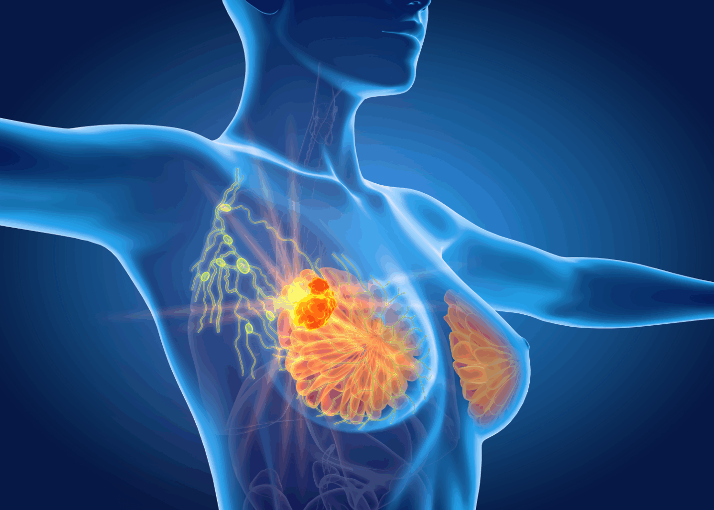 ΕΕΜ – Καρκίνος μαστού: Νέες συστάσεις για πρόληψη – Τι αλλάζει στον έλεγχο