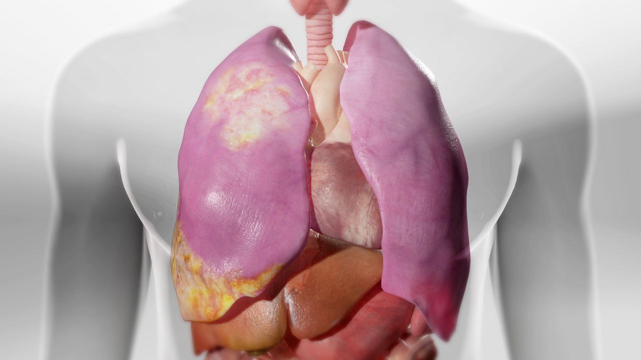 Μεσοθηλίωμα: Η σπάνια αλλά θανατηφόρος νόσος που σχετίζεται με τον αμίαντο Μεσοθηλίωμα:-Η-σπάνια-αλλά-θανατηφόρος-νόσος-που-σχετίζεται-με-τον-αμίαντο