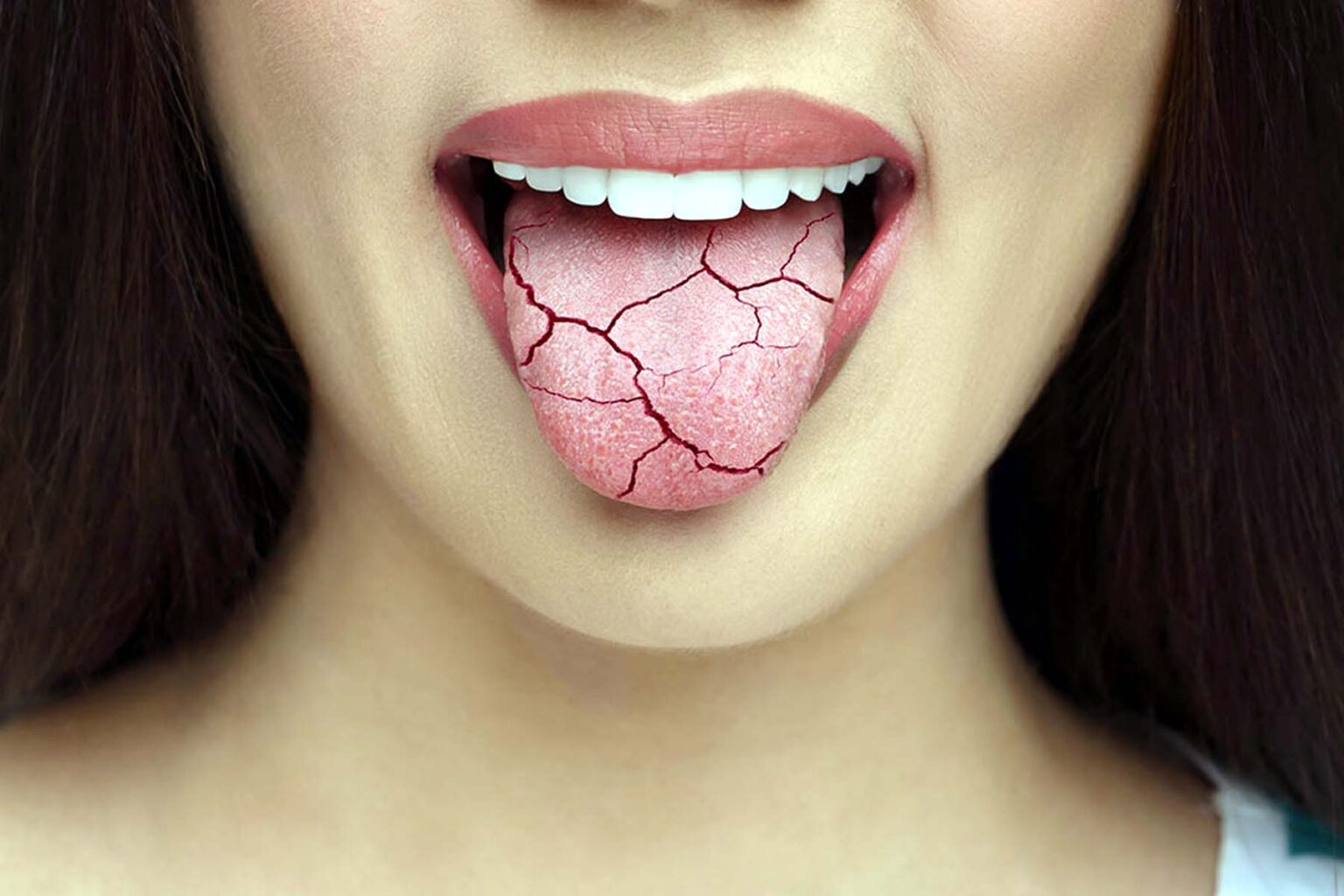 Ξηροστομία: Ένας «σιωπηλός» εχθρός των δοντιών xirostomia-