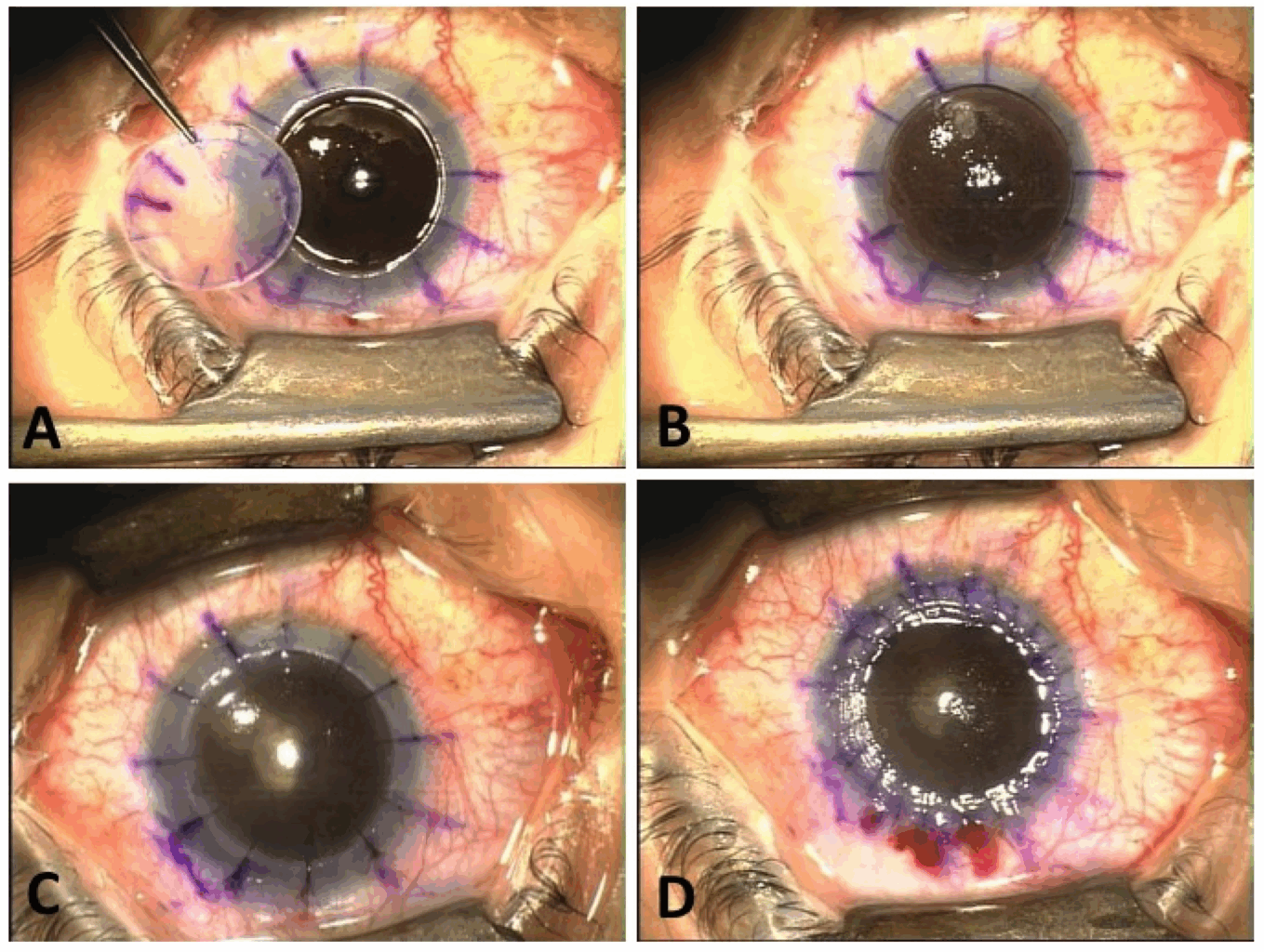 Έγκριση FDA νέας θεραπείας για τον κερατόκωνο, από τη Glaukos Corp – Άνοδος των μετοχών της εταιρείας