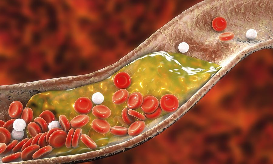Νέα γονιδιακή θεραπεία μειώνει τη χοληστερόλη κατά 50% χωρίς στατίνες lipos-artiries-