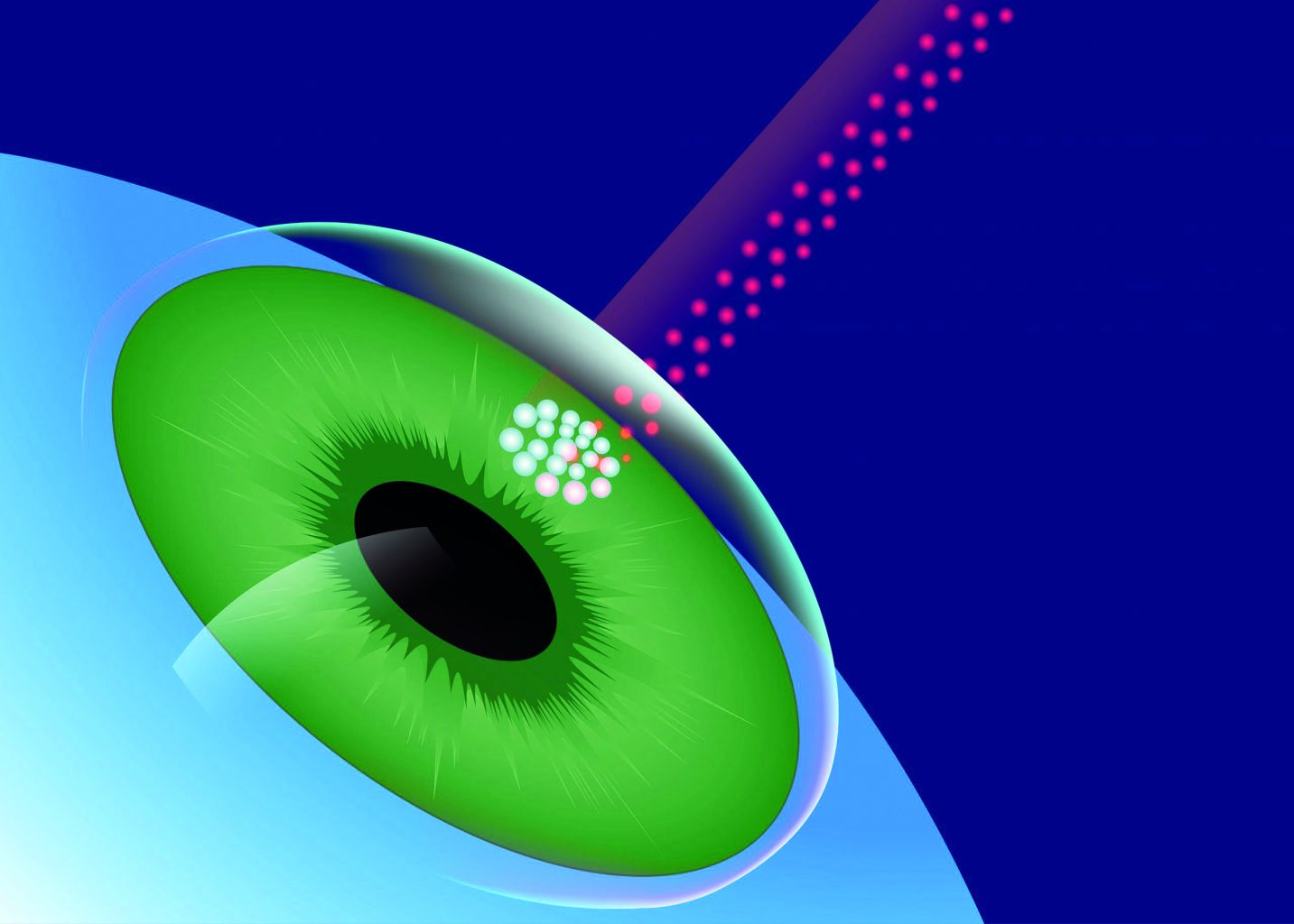 γλαύκωμα αντιμετώπιση χωρίς φάρμακα