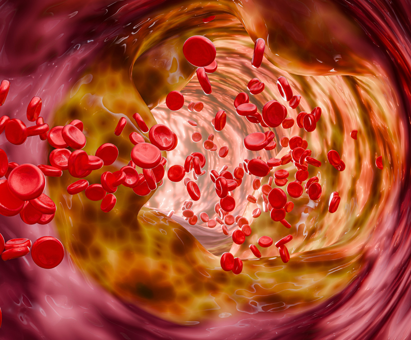 Περιφερική αρτηριοπάθεια: Διάγνωση και σύγχρονες θεραπευτικές επιλογές περιφερική αρτηριοπάθεια